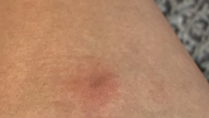 Help why do I have itchy red bumps on my body?