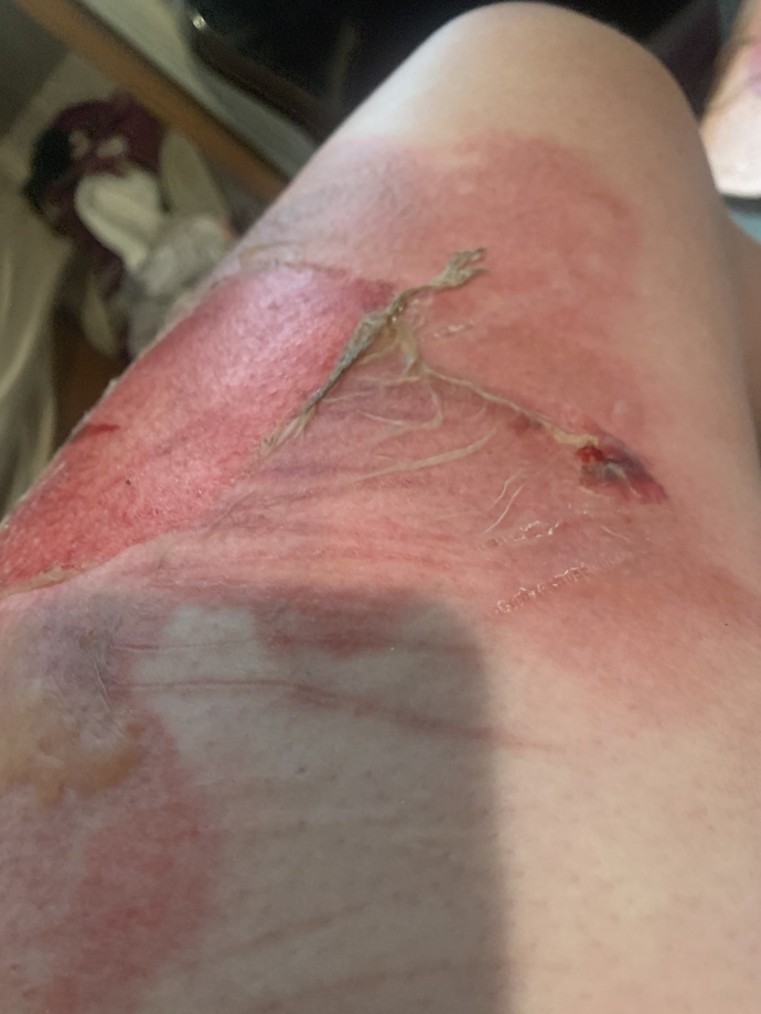 Should I go to the doctor for this burn?