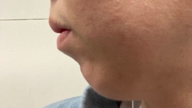 Do you think I look like a good candidate for sliding genioplasty?