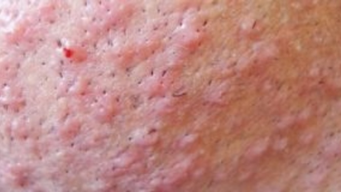 What do use to get rid of razor bumps & men do you care about them?
