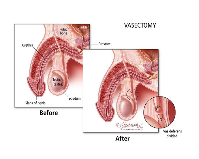 Instead of banning abortion should unmarried men get reversible vasectomies?