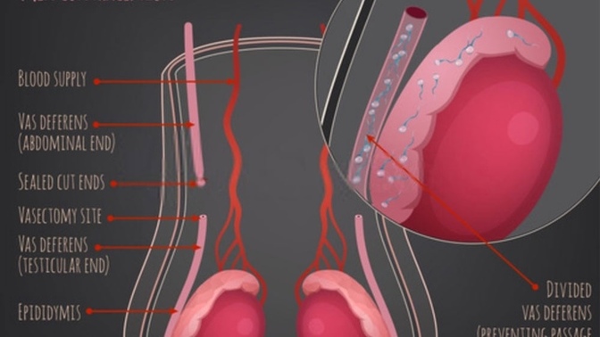 Instead of banning abortion should unmarried men get reversible vasectomies?