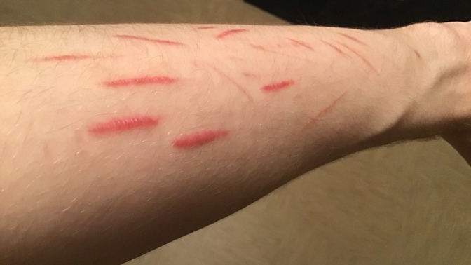 Will my scars fade?