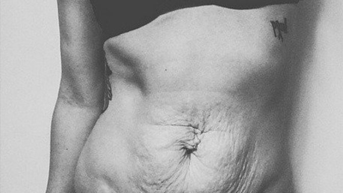 Girls, be honest, would you wear a bikini if your tummy looked like this?