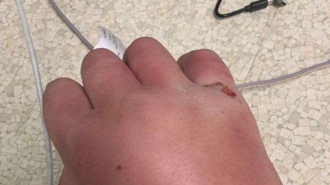 Broken knucles?