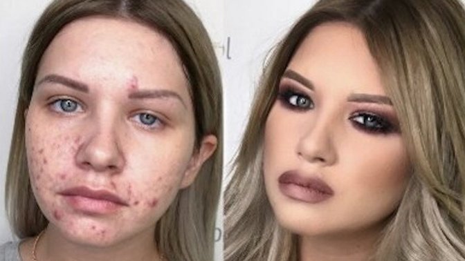How many females have acne like this under all that fakeup?