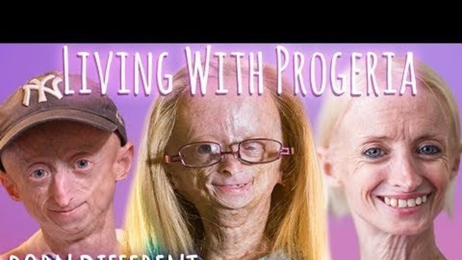 How would you look at life if you had Progeria?