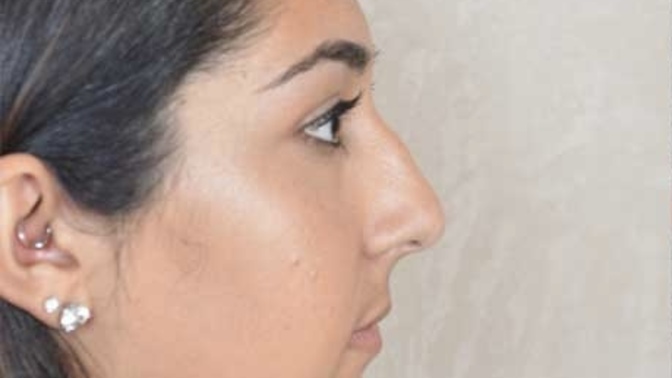 Guys, do you dislike big noses on girls?