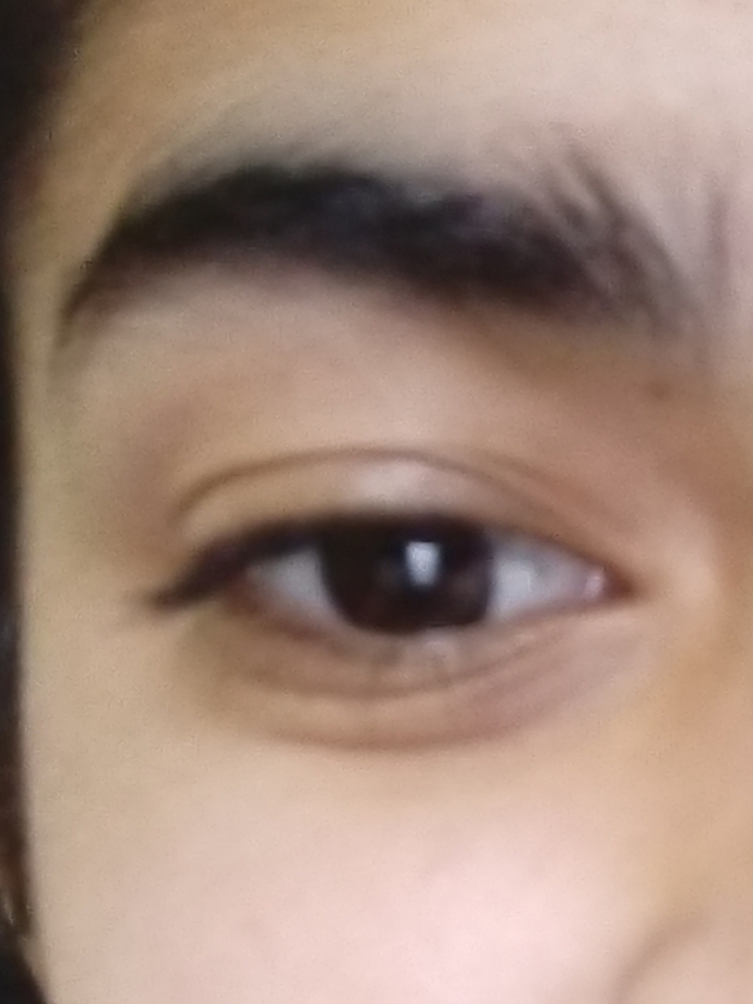 Im just 17 and I got smile lines under eye im sure its due to my high screen time, lack of sleep. How do I reverse it?