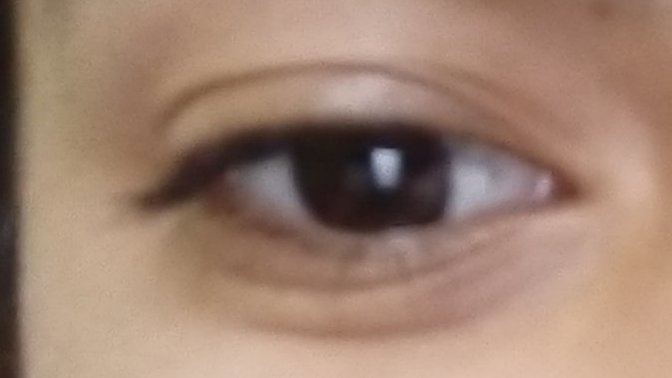 Im just 17 and I got smile lines under eye im sure its due to my high screen time, lack of sleep. How do I reverse it?