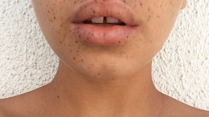 Are teeth gaps seen as ugly?