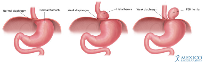 Have you had a hiatial hernia?