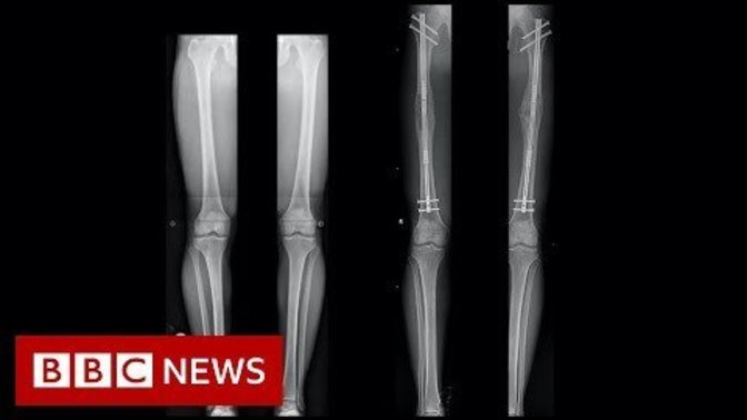 Would you date a person who has had leg lengthening surgery? If not, why?