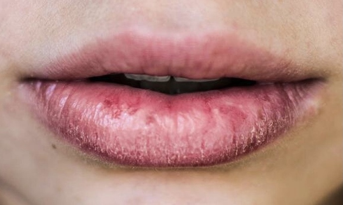 Do you get really chapped lips this time of year?