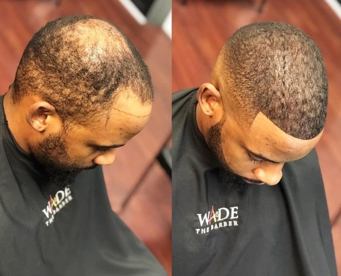 When men are balding, why don’t they embrace it?