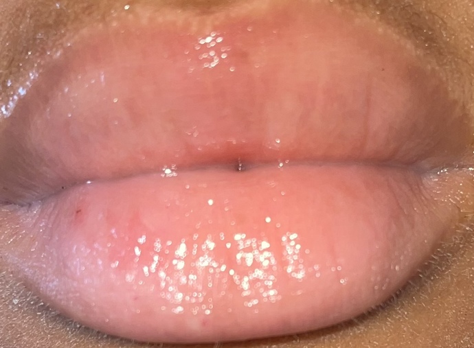 Does it look like I’m losing color in my top lip? Does it look like herpes are forming?