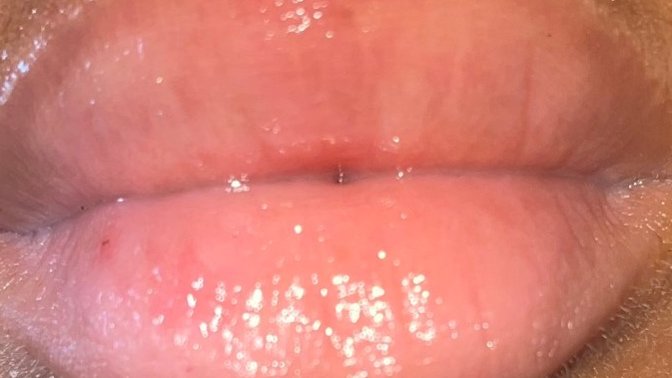 Does it look like I’m losing color in my top lip? Does it look like herpes are forming?