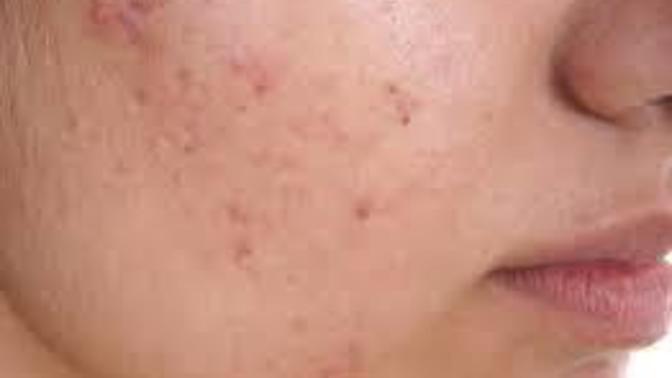 Did you ever wanted to get rid of acne so bad that you can't even find a right way to get rid of it?