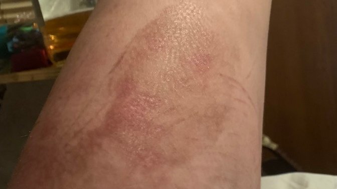 Could you still live a person with a scar like this on her thigh?