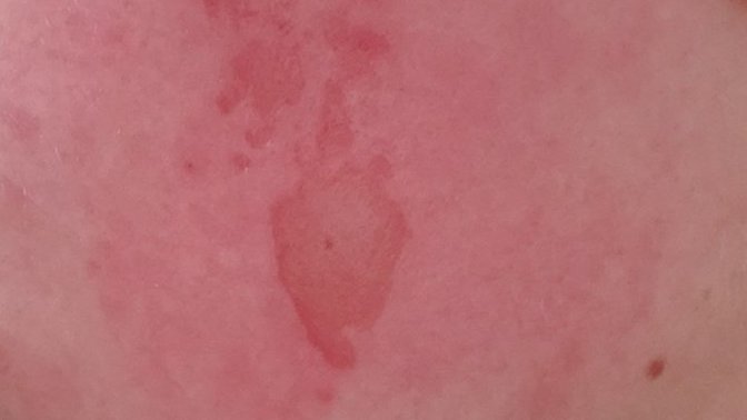 I pulled off big chunks of skin from waxing. Wtf do I do?