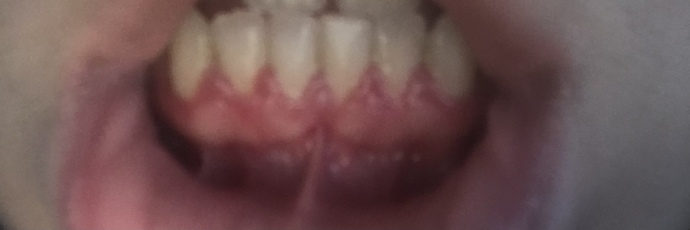 How can I fix my gum🥺?