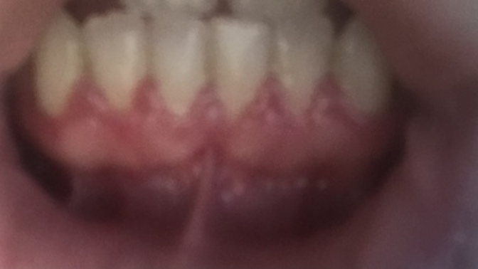 How can I fix my gum🥺?