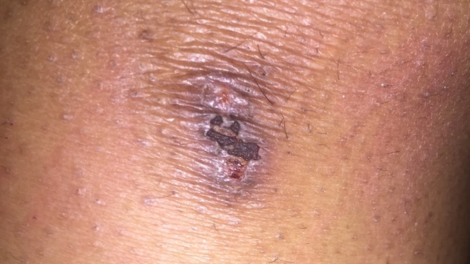 Warning ⚠️ gross picture? should I go to the doctor for this?