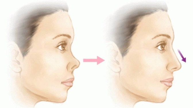 Is it ture upturned nose is beautiful in it's group?