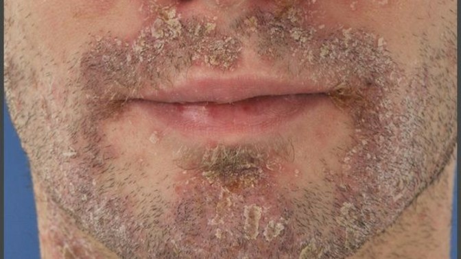 Skin Health: How To Properly Treat Psoriasis Under the Beard?