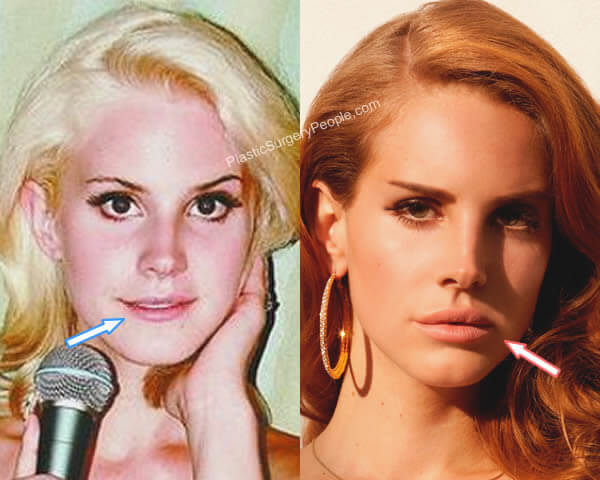 Are fuller lips in trend because of Angelina jolie?
