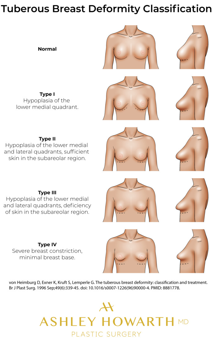 How would you react if you found out a girl you were interested in had deformed breasts?