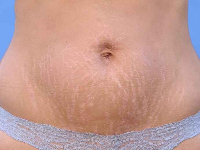Guys, would you be ok if your wife/girlfriend gets loose saggy skin from pregnancy? Can you avoid getting saggy loose skin?