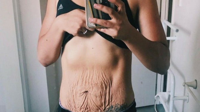 Guys, would you be ok if your wife/girlfriend gets loose saggy skin from pregnancy? Can you avoid getting saggy loose skin?