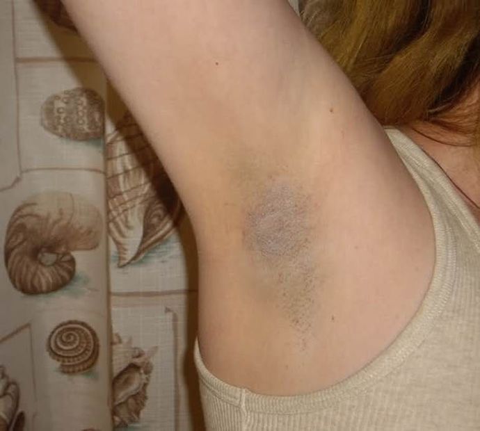 What is the best solution for armpit and groin darkness?