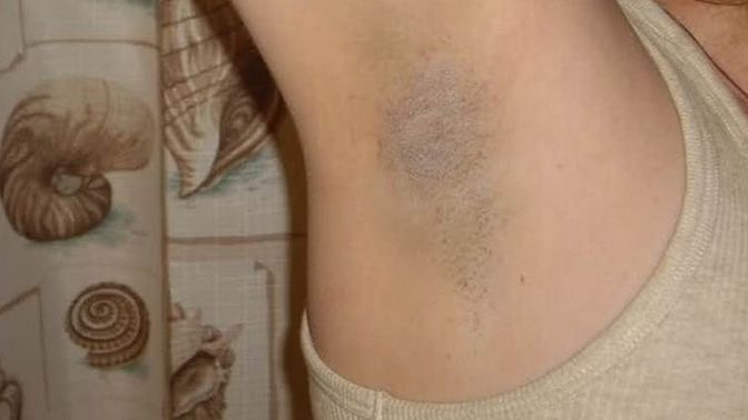 What is the best solution for armpit and groin darkness?