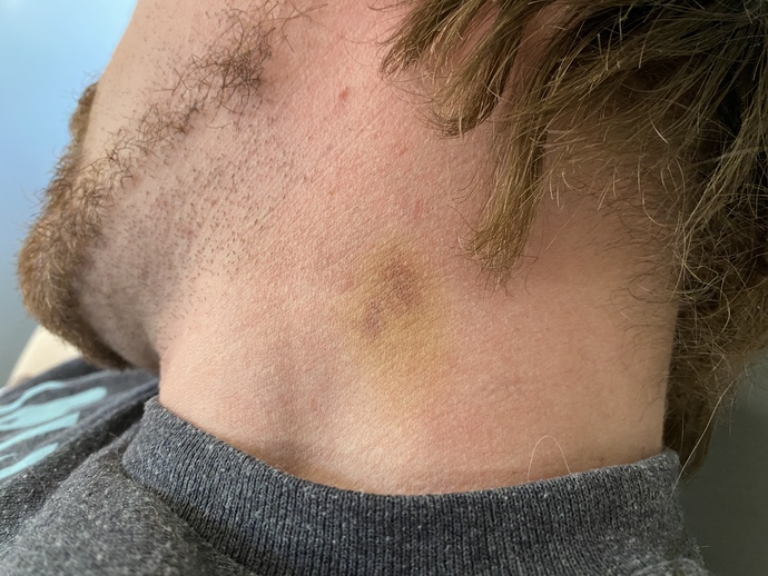 Is this a hickey?