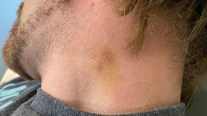 Is this a hickey?