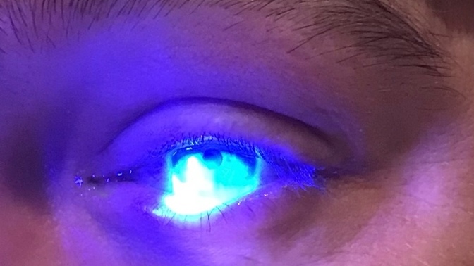 Have you ever had a bad corneal abrasion?