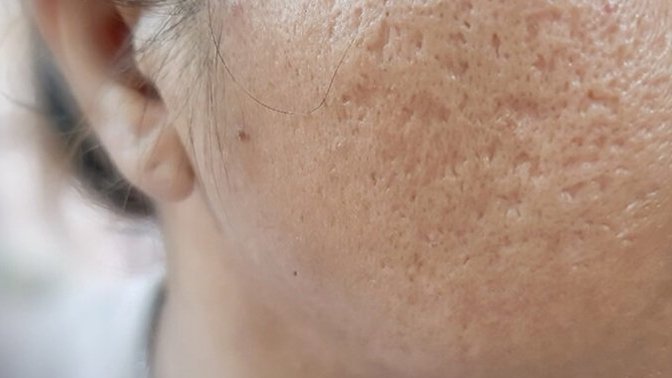 Would you go out or make out with someone who has acne scars but still pretty?