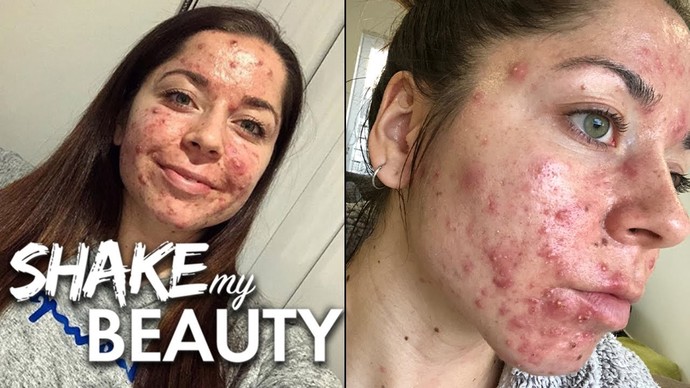 Do you agree cystic acne makes a person unappealing for Jobs, dates, friends, etc. ?