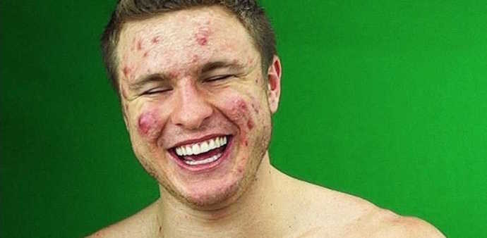Do you agree cystic acne makes a person unappealing for Jobs, dates, friends, etc. ?