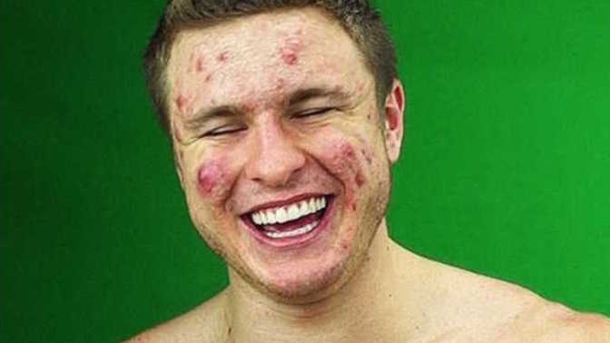 Do you agree cystic acne makes a person unappealing for Jobs, dates, friends, etc. ?