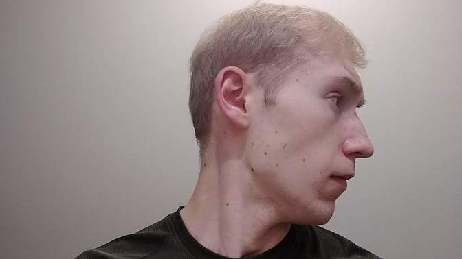 Have I made the wrong decision (cosmetic treatment)?
