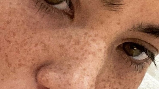 What are your thoughts on freckles, and are they attractive?