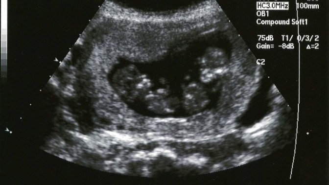 This is a difficult question to answer. Can you possibly be having twins when you recieved a heartbeat of 150 on the left side, and 160 on the right?