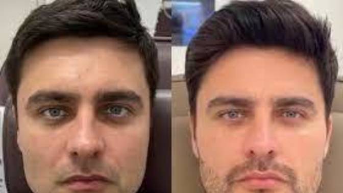 Women, would you date a guy who's done facial harmonization?