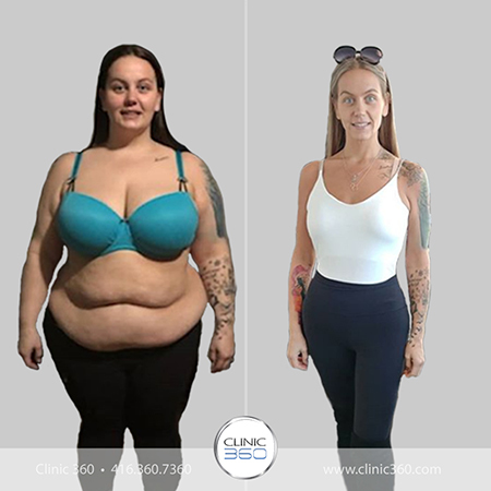 Should I get weight loss surgery?