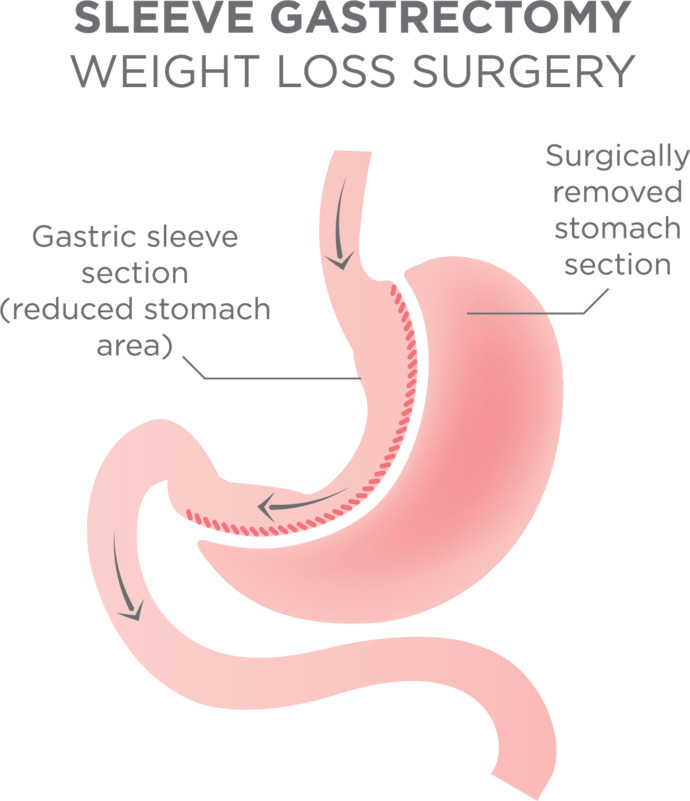 Should I get weight loss surgery?