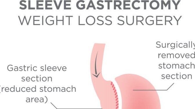 Should I get weight loss surgery?