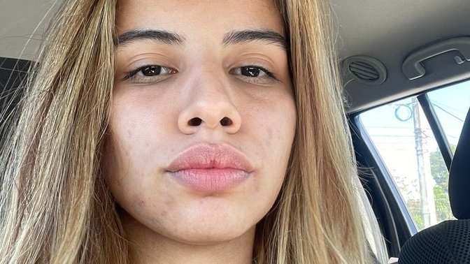 My acne is getting worse?